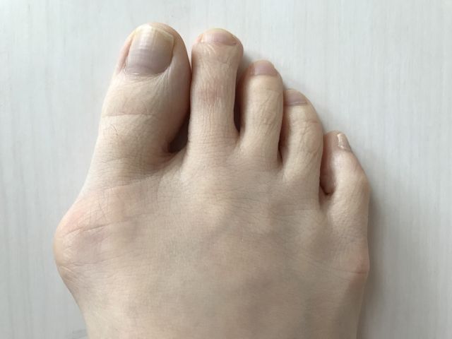 親指がくの字に曲がる！足の病気「外反母趾」とは？